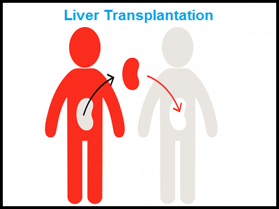 Liver Diseases & Transplantation - Dr. Sachin Palnitkar