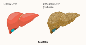 Liver Disorder