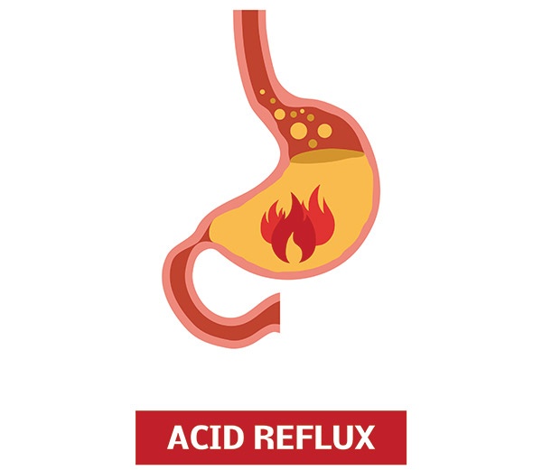 ACID REFLUX