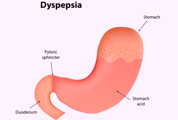 Dyspepsia