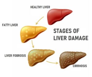 Non-Alcoholic Fatty Liver Disease